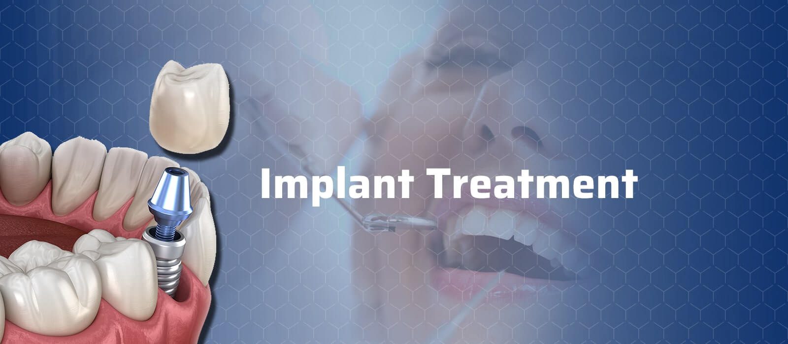 Implant Treatment